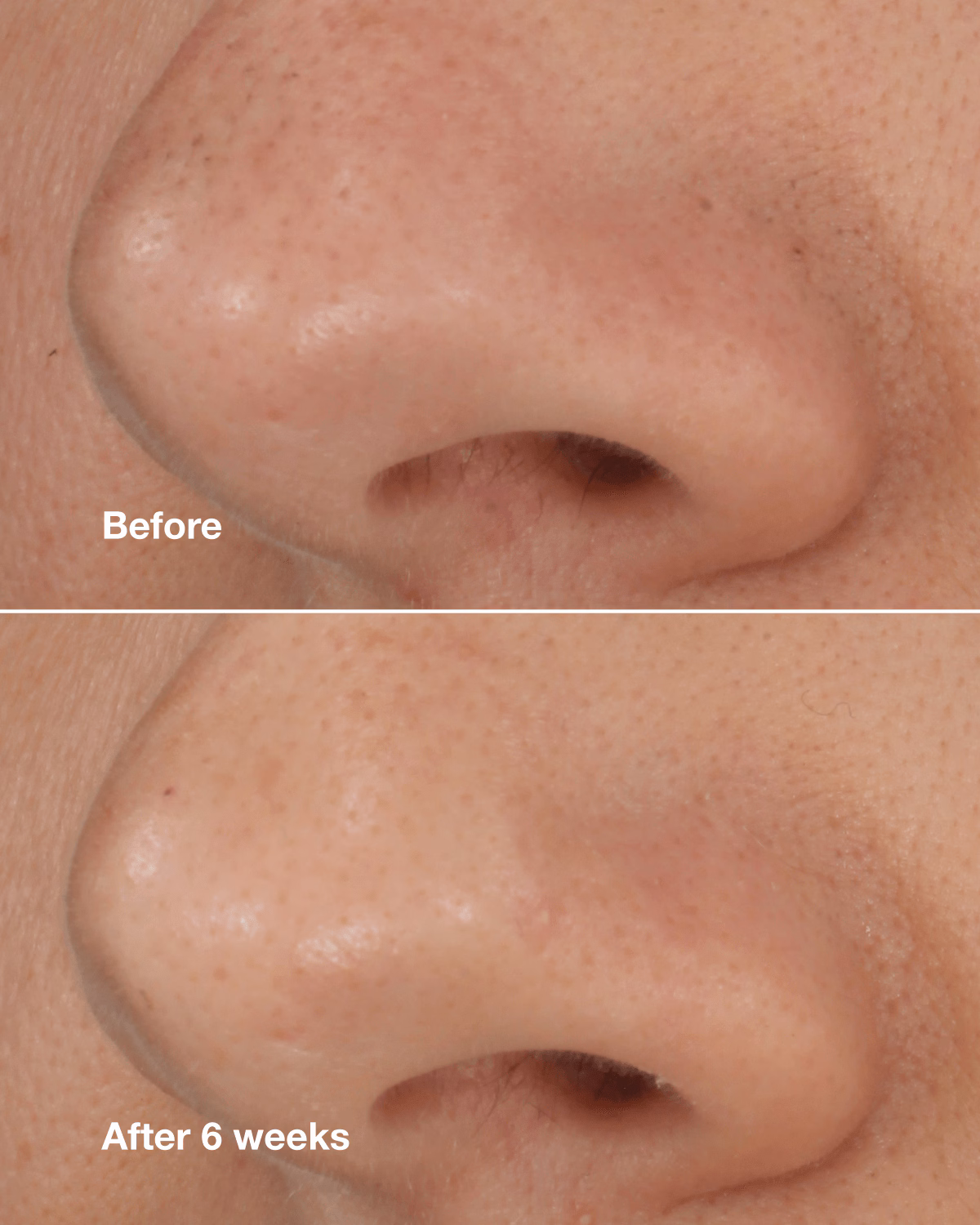 Blackhead Solutions Self-Heating Blackhead Extractor